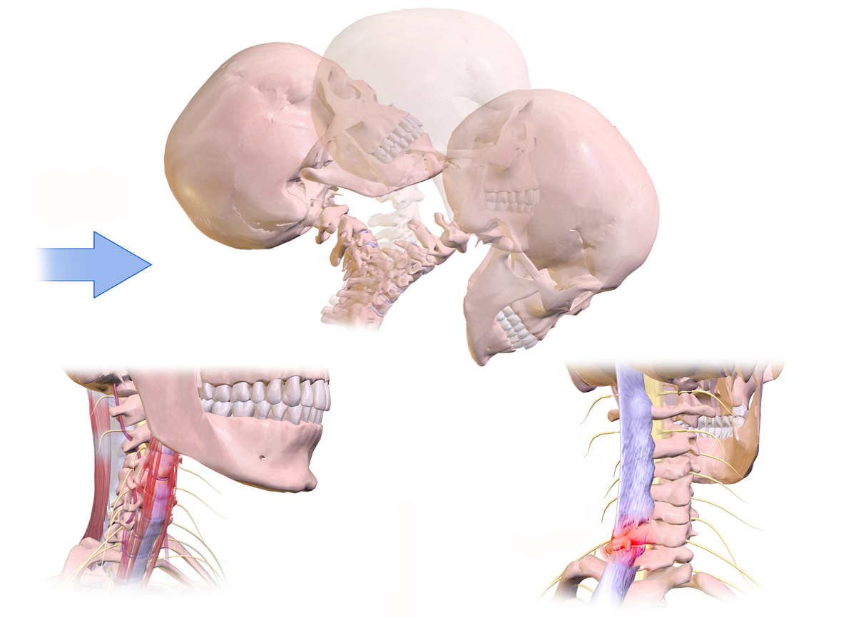 Whiplash injury